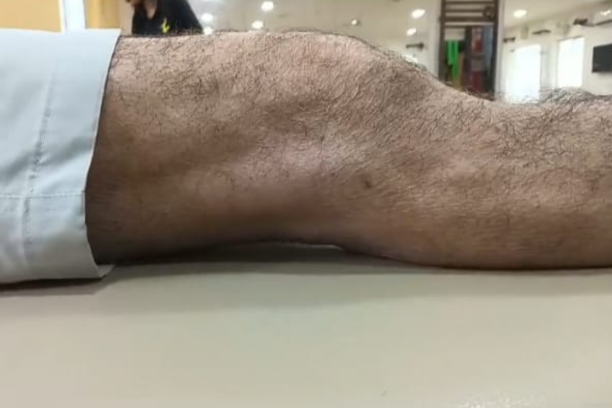 Osteoarthritis